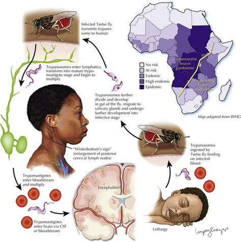 Parasitic and Fungal Disorders and Neurosarcoidosis | Neupsy Key