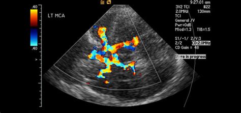 Ultrasound's Transcranial Doppler Imaging Checks for Risk of Stroke ...