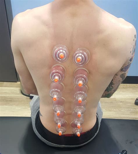 What is Cupping? - ATP