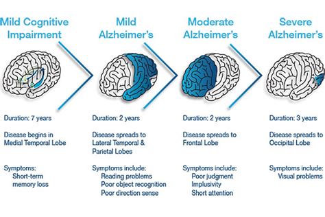 What are the Three Stages of Alzheimer’s Disease - Senior Directory