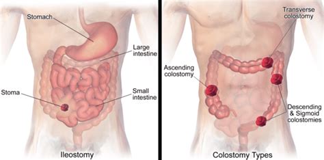 Ostomy (ileostomy or colostomy) | Dr. Nikhil Agrawal