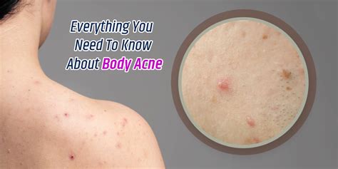 Body Acne Symptoms Causes And Treatment | Onlymyhealth