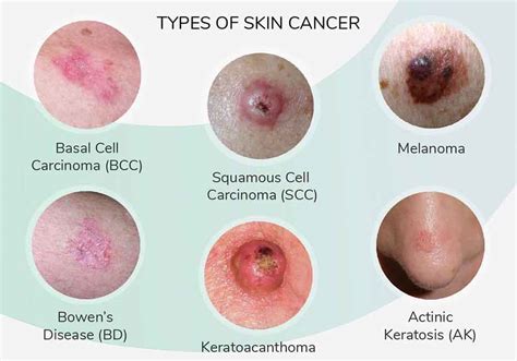 Skin Cancer; Types, Images, Symptoms, Rash, Spots, Bumps & Skin Cancer ...