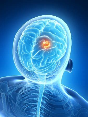 Brain Lesions Treatment | Blue Ridge Radiation Oncology