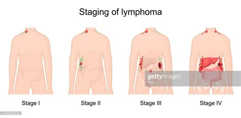 Hodgkin's lymphoma | JanineTigerlily