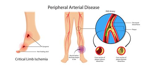 Amputation Prevention & Limb Preservation | CTVS Central Texas