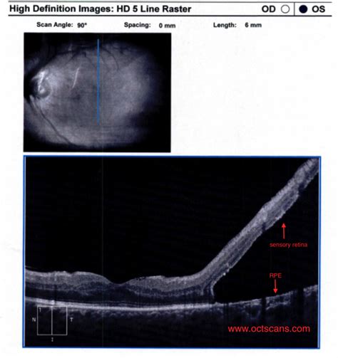 Retinal Detachment - Optical Coherence Tomography Scans