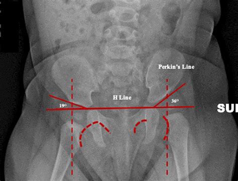 Pediatric Hip Disorders | Radiology Key