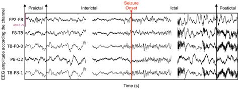 Seizure Eeg Machine