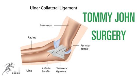 Ulnar Collateral Ligament Tommy John