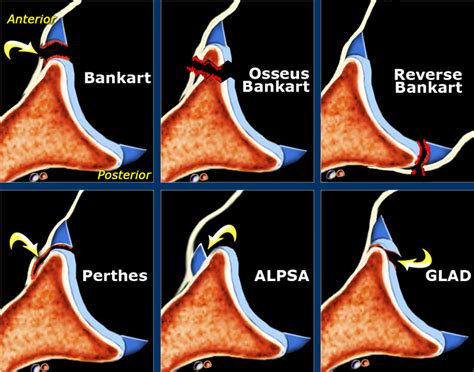 MRI Musculo-Skeletal Section: Bankart and variants