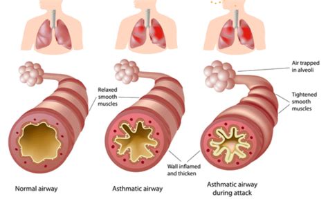 Asthma or COPD: How to Tell the Difference? | Medanta