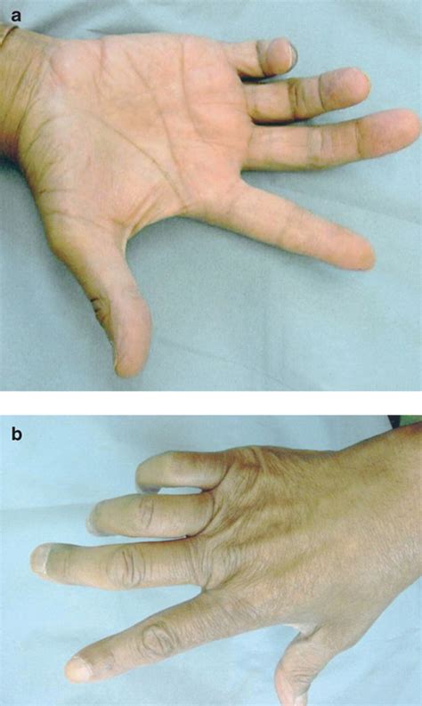 Ulnar claw hand with flexion deformity of the ring and little fingers ...