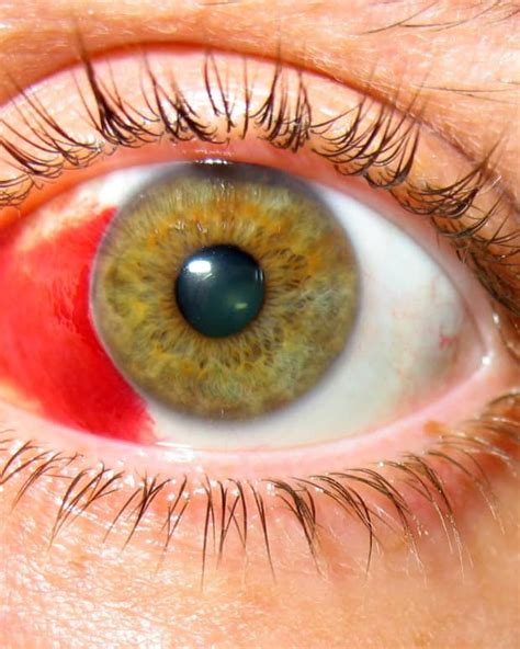 What Causes Broken or Burst Blood Vessels in the Eyes? - YouMeMindBody