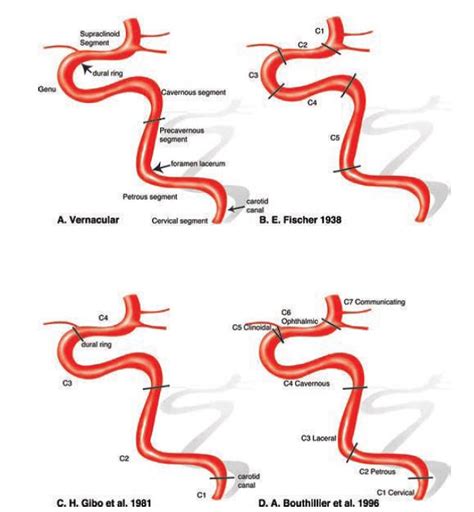 내경 동맥 다양한 해부학적 분류 (ICA segment anatomy) | 신경중재최근동향 | 커뮤니티 | 신경중재클리닉 ...