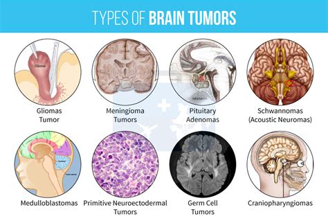 Quais são os 3 tipos de tumores? – jshot.info