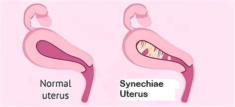 What is Synechiae Uterus and How to Treat It in 2023?