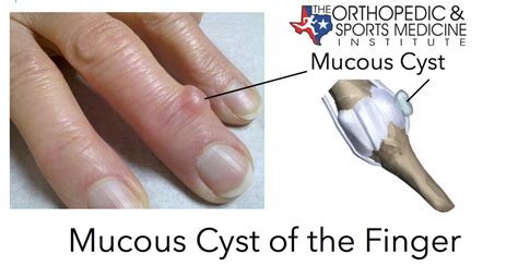 Digital Mucous Cyst Nail Bed - Nail Ftempo