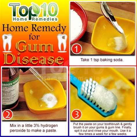 Natural Home Remedies for Gum Disease | Top 10 Home Remedies