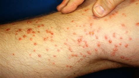 Fire Ants: Symptoms and Treatments