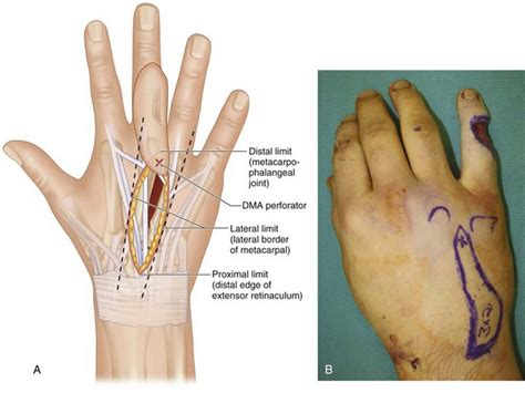 44: Dorsal Metacarpal Artery Perforator Flap | Clinical Gate