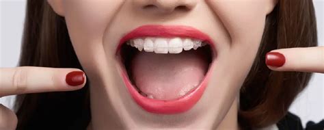 10 Benefits of Clear Bracket Braces - Smile Bright