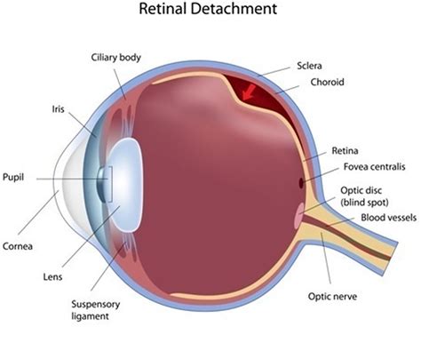 Retinal Detachment - Causes, Signs, Symptoms, Surgery, Repair