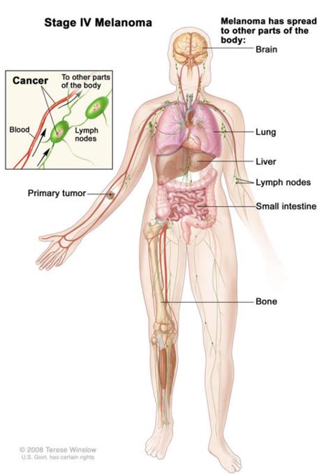 Stage 4 Metastatic Melanoma