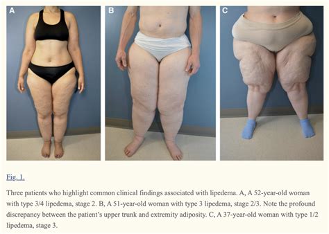 Learn About Stages and Types of Lipedema | Lipedema.net