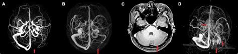 Frontiers | Anatomy imaging and hemodynamics research on the cerebral ...