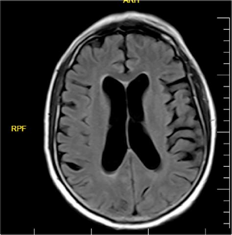 Brain MRI FLAIR sequence. | Download Scientific Diagram