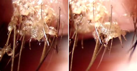 This horrifying close-up video of eyelash lice will give you nightmares ...