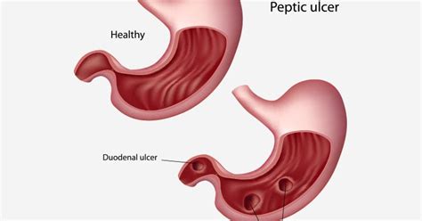 Curling's Ulcer Signs and Symptoms, Causes, Diagnosis, Treatment ...