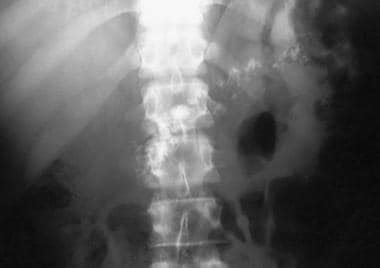 Chronic Pancreatitis X Ray