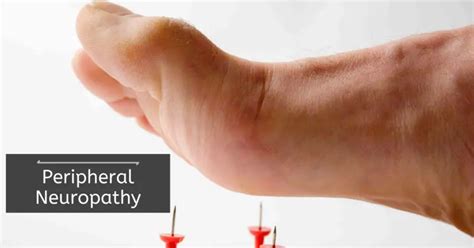 Peripheral Neuropathy - Types | Symptoms | Causes | Risk Factors ...