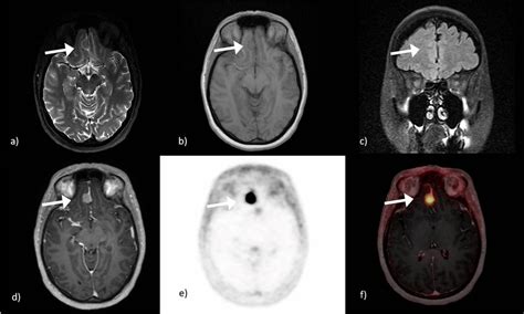 61 years old female patient with a typical falcine meningioma in the ...