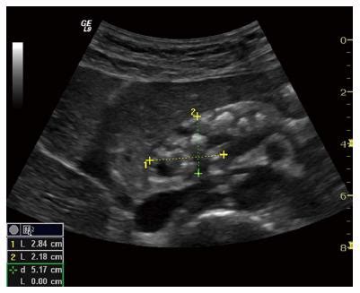 Pancreas Ultrasound