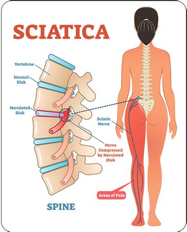 Sciatica Treatment, Symptoms & Causes | ANSSI