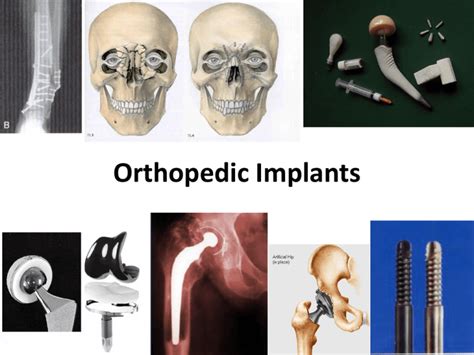 Orthopedic Implants