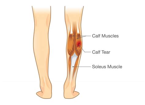 Common Lower Leg and Calf Injuries - My Family Physio