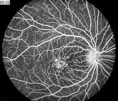 Fluorescein angiography of Stargardt's Disease, a.k.a. Juvenile Macular ...