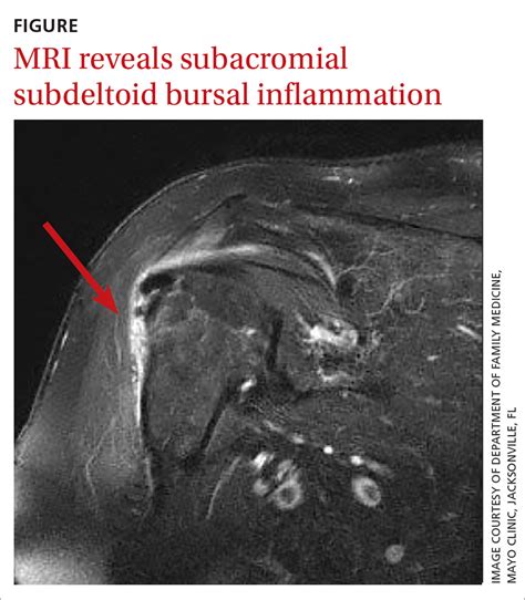 Subacromial Subdeltoid Bursitis Mri