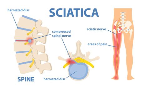 Sciatica: Causes, Symptoms, and Effective Exercises