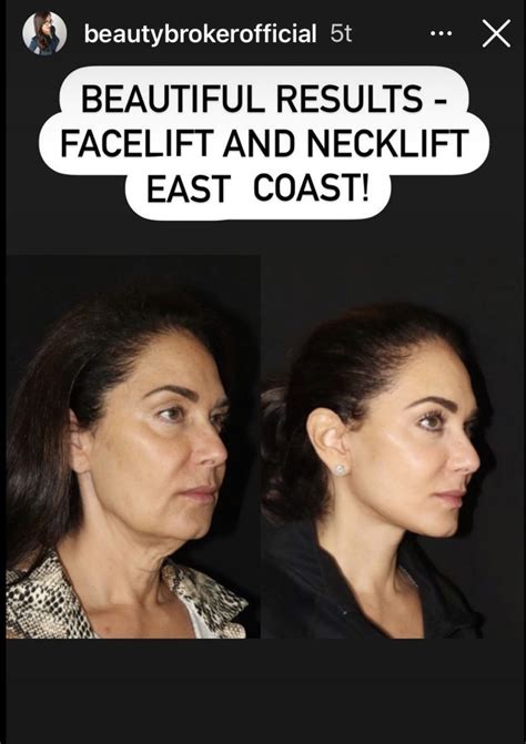 Mini facelift vs full facelift what you need to know – Artofit