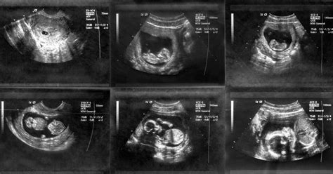 12 Weeks Pregnant Ultrasound Girl