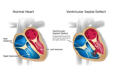 Ventricular Septal Defect | My Doctor Online