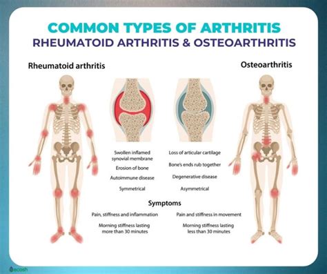 RHEUMATOID ARTHRITIS (RA) - Symptoms, Causes, Risk Groups, Treatment ...