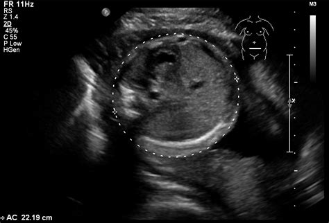 Fetal hydantoin syndrome - wikidoc