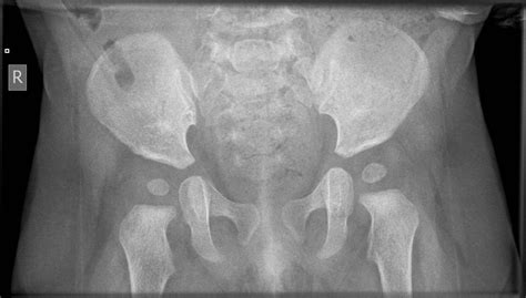 NORMAL PEDIATRIC BONE XRAYS - BoneXray.com