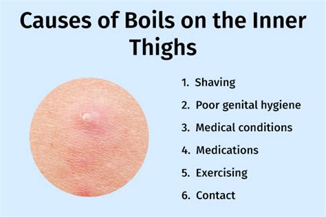 How To Prevent Getting Boils - Forcesurgery24